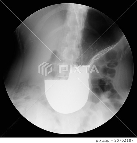 バリウム検査 胃 バリウム検査 胃 50702187