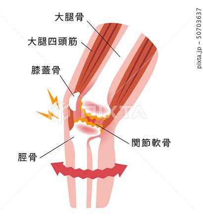 膝の関節痛 変形性膝関節症 発生の仕組みと原因 イラストのイラスト素材