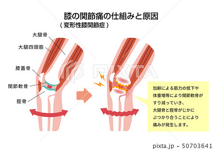 膝の関節痛 変形性膝関節症 発生の仕組みと原因 イラストのイラスト素材
