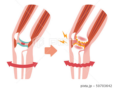 膝の関節痛 変形性膝関節症 発生の仕組みと原因 イラスト 文字なし のイラスト素材