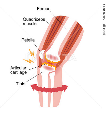 膝の関節痛 変形性膝関節症 発生の仕組みと原因 イラストのイラスト素材