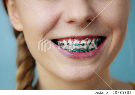 Closeup of woman teeth with braces Closeup of woman teeth with braces 50735382