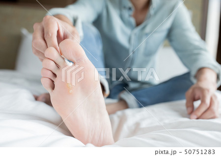 applying cream for athletes foot 50751283