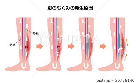 脚のむくみ 浮腫 の発生原因 過程 イラストのイラスト素材