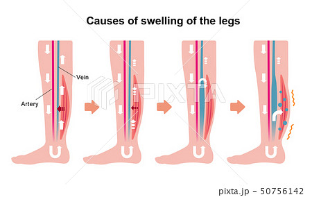 脚のむくみ 浮腫 の発生原因 過程 イラスト 英語 のイラスト素材