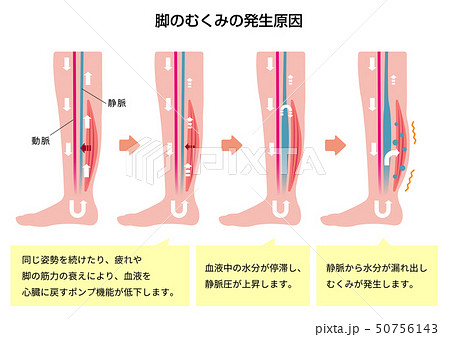 脚のむくみ 浮腫 の発生原因 過程 イラストのイラスト素材