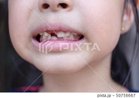 little child and broken teeth little child and broken teeth 50756667