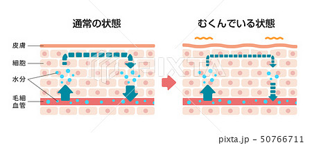 皮膚断面図イラスト / むくみ（浮腫）の発生した皮膚と通常の皮膚 比較図 50766711