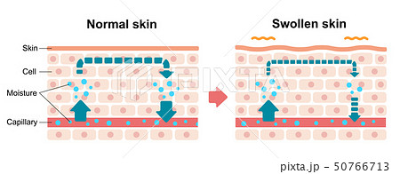 皮膚断面図イラスト むくみ 浮腫 の発生した皮膚と通常の皮膚 比較図 英語 のイラスト素材