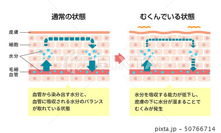 皮膚断面図イラスト むくみ 浮腫 の発生した皮膚と通常の皮膚 比較図 解説文付き のイラスト素材