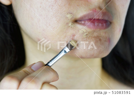 Cosmetics acne, Asian woman applying concealer 51083591