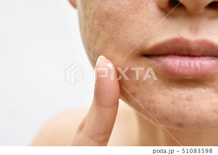 Acne and face skin problem, Woman applying acne 51083598