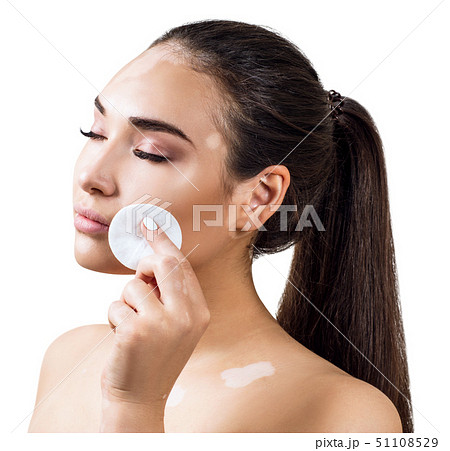 Beautiful young woman with vitiligo wiping her face with cotton disk. Beautiful young woman with vitiligo wiping her face with cotton disk. 51108529