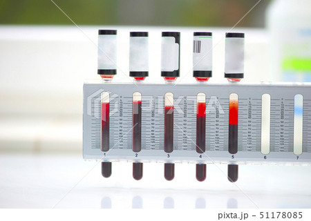 Erythrocyte sedimentation rate test in laboratory 51178085