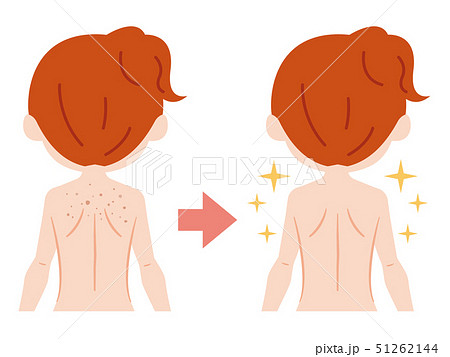背中のビフォーアフター 毛穴 ブツブツ 背中のビフォーアフター 毛穴 ブツブツ 51262144