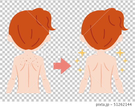 背中のビフォーアフター 毛穴 ブツブツ 背中のビフォーアフター 毛穴 ブツブツ 51262144