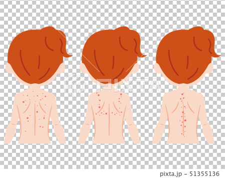 背中　女性　ブツブツ 51355136