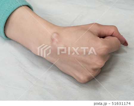Big cyst (hygroma) 51631174