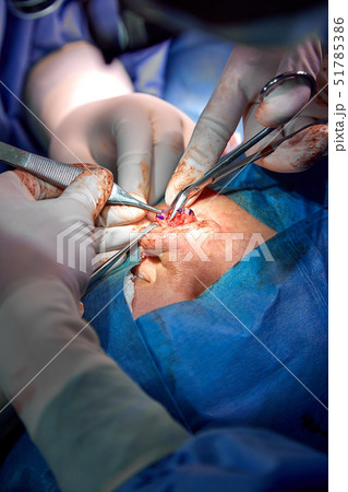 Rhinoplasty close-up of nose surgery. The hands of the surgeon working tools in white gloves Rhinoplasty close-up of nose surgery. The hands of the surgeon working tools in white gloves 51785386