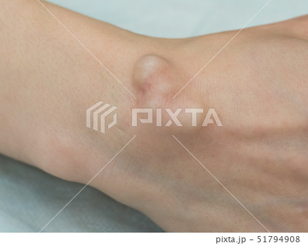 Big cyst (hygroma) Big cyst (hygroma) 51794908