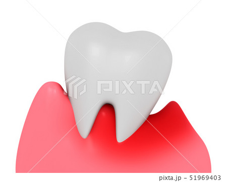 歯の病気 歯の病気 51969403
