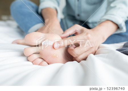 applying cream for athletes foot 52396740