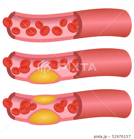 血管（コレステロール） 52970157