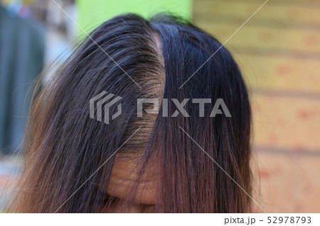 Hair loss, baldness and dandruff on the scalp Hair loss, baldness and dandruff on the scalp 52978793
