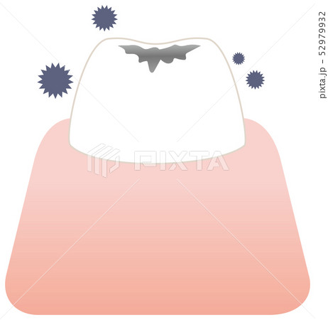 虫歯菌がついている歯 イラストのイラスト素材