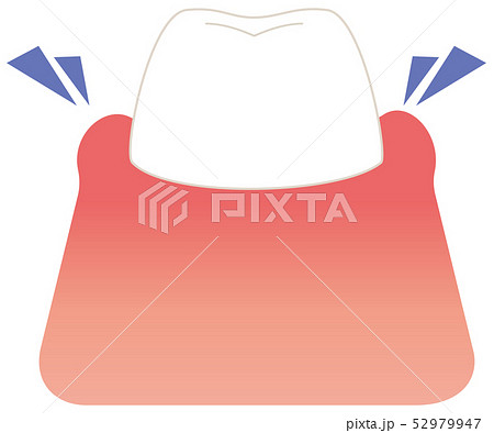 腫れている歯 イラスト 腫れている歯 イラスト 52979947