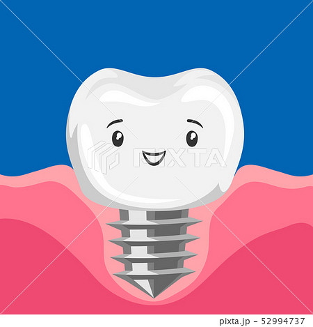 Illustration of smiling tooth implant. 52994737