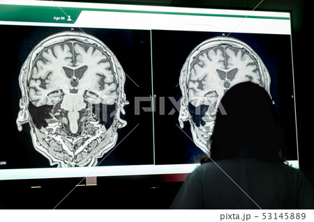MRI indicated Dementia MRI indicated Dementia 53145889