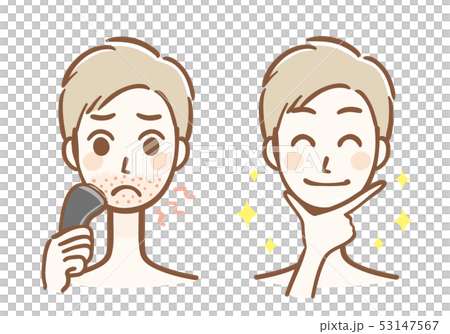 カミソリ負け　脱毛　男性　ビフォーアフター 53147567