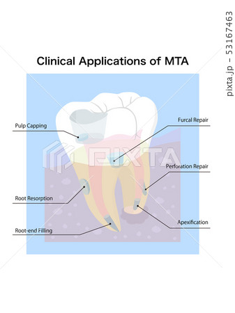歯科MTA治療説明 53167463