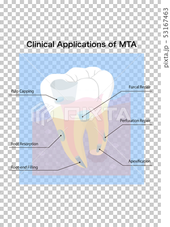 歯科MTA治療説明 53167463