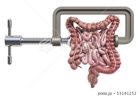 Abdominal pain concept. Vise with human bowel Abdominal pain concept. Vise with human bowel 53191252