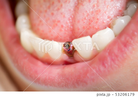 Dentist tools. Beautiful young woman smile with 53206179