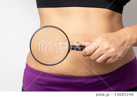 Women Show off the belly after birth. Stretch Mark 53685240