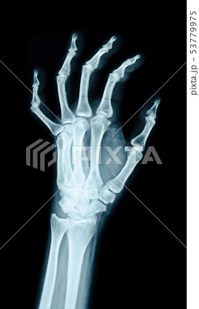 X-ray image of the hand. X-ray image of the hand. 53779975
