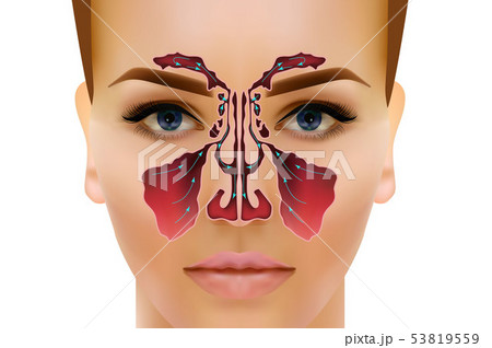 Sinusitis. Healthy and inflammation nasal sinus vector illustration 53819559