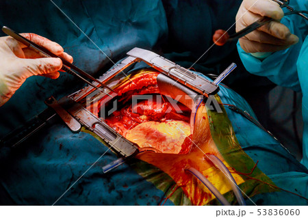 Heart surgery in the surgical operating room Heart surgery in the surgical operating room 53836060