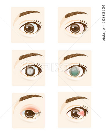 目の病気 53838504