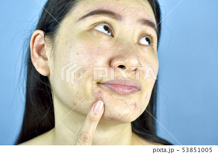 Asian woman finger point at whitehead acne. 53851005