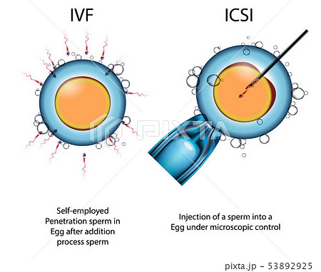 types of artificial fertilization of the egg by sperm ECO und ICSI types of artificial fertilization of the egg by sperm ECO und ICSI 53892925