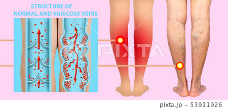 Varicose Veins on a Female Legs Stock Photo - Image of medical, senior:  102758888