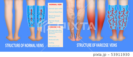 Varicose veins on a female senior legs. The 53911930