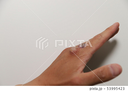 ウイルス性いぼの治療 53995423