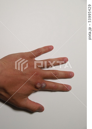 ウイルス性いぼの治療 53995429