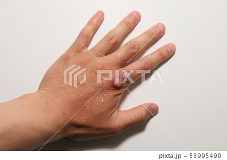 ウイルス性いぼの治療 ウイルス性いぼの治療 53995490