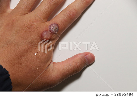 ウイルス性いぼの治療 53995494